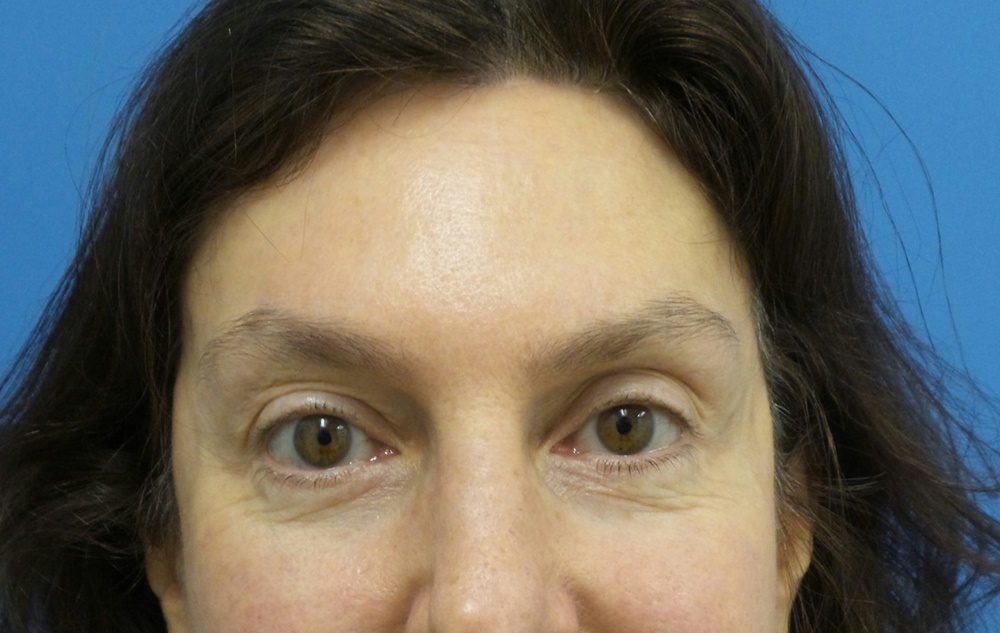 Eyelid Surgery Before And After Photos By Michael Epstein, MD, FACS ...