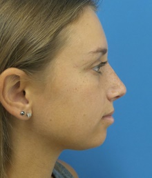 Rhinoplasty After Photo by Michael Epstein, MD, FACS; Northbrook, IL - Case 42505