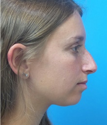 Rhinoplasty Before Photo by Michael Epstein, MD, FACS; Northbrook, IL - Case 42505