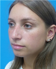 Rhinoplasty Before Photo by Michael Epstein, MD, FACS; Northbrook, IL - Case 42505
