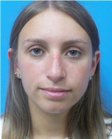 Rhinoplasty Before Photo by Michael Epstein, MD, FACS; Northbrook, IL - Case 42505
