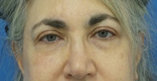 Eyelid Surgery After Photo by Michael Epstein, MD, FACS; Northbrook, IL - Case 42991
