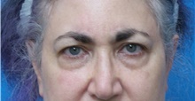 Eyelid Surgery Before Photo by Michael Epstein, MD, FACS; Northbrook, IL - Case 42991