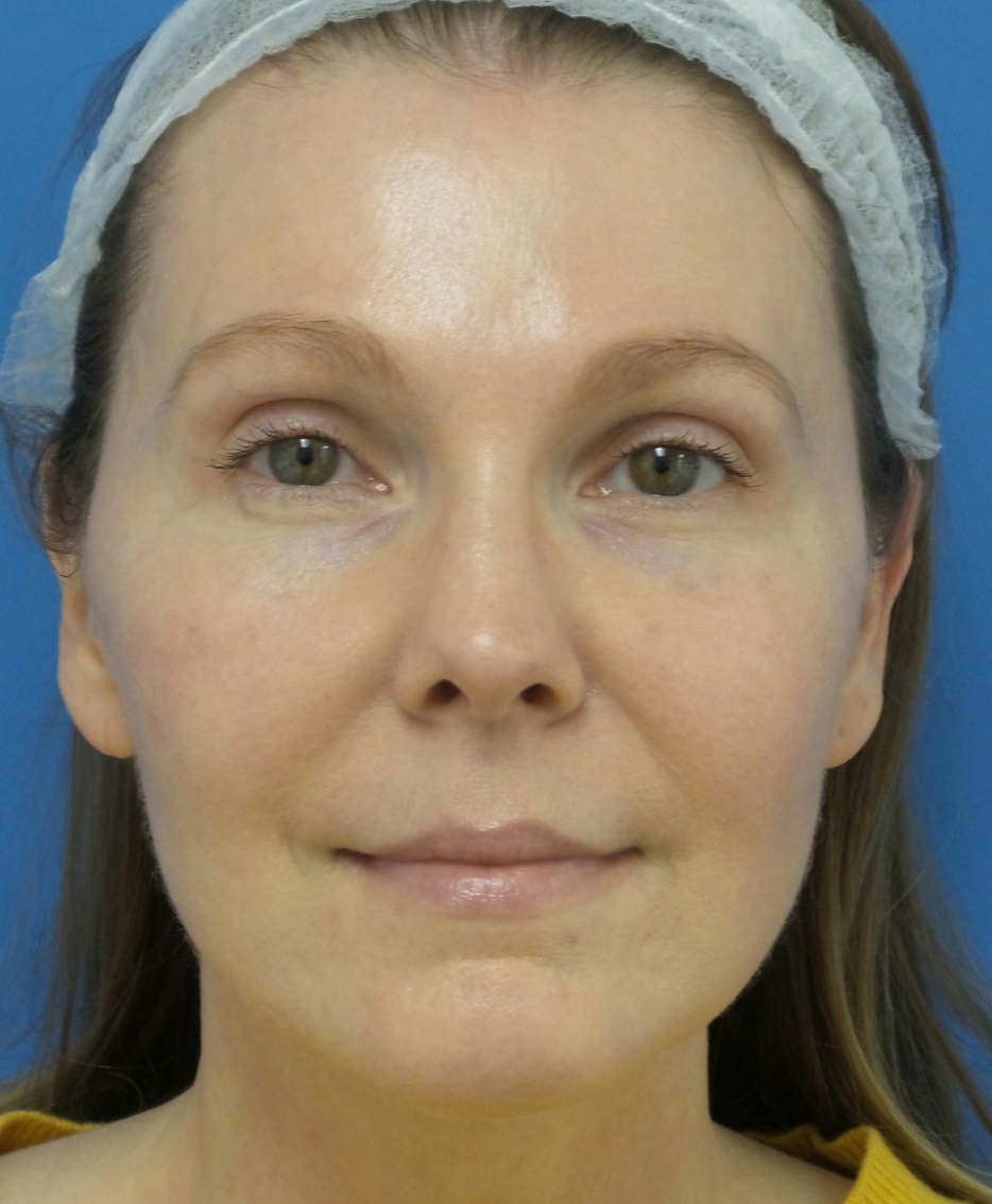 Brow Lift Before and After Photos by Michael Epstein, MD, FACS ...