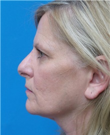 Rhinoplasty Before Photo by Michael Epstein, MD, FACS; Northbrook, IL - Case 43115