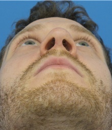 Rhinoplasty After Photo by Michael Epstein, MD, FACS; Northbrook, IL - Case 43305