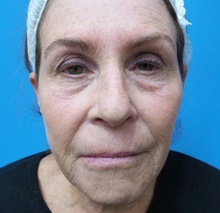 Eyelid Surgery Before Photo by Michael Epstein, MD, FACS; Northbrook, IL - Case 43980