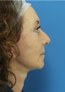 Facelift After Photo by Michael Epstein, MD, FACS; Northbrook, IL - Case 44213