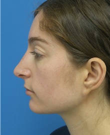 Rhinoplasty After Photo by Michael Epstein, MD, FACS; Northbrook, IL - Case 44304