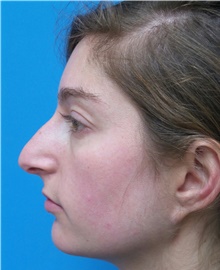 Rhinoplasty Before Photo by Michael Epstein, MD, FACS; Northbrook, IL - Case 44304