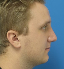 Rhinoplasty After Photo by Michael Epstein, MD, FACS; Northbrook, IL - Case 44543