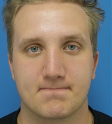 Rhinoplasty After Photo by Michael Epstein, MD, FACS; Northbrook, IL - Case 44543