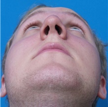Rhinoplasty Before Photo by Michael Epstein, MD, FACS; Northbrook, IL - Case 44543