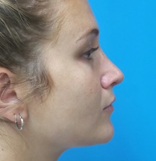 Rhinoplasty After Photo by Michael Epstein, MD, FACS; Northbrook, IL - Case 44637