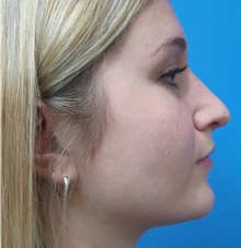 Rhinoplasty Before Photo by Michael Epstein, MD, FACS; Northbrook, IL - Case 44637