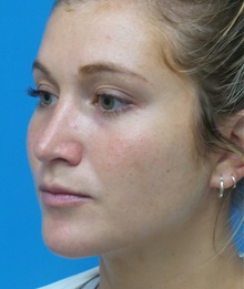 Rhinoplasty After Photo by Michael Epstein, MD, FACS; Northbrook, IL - Case 44637