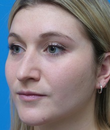 Rhinoplasty Before Photo by Michael Epstein, MD, FACS; Northbrook, IL - Case 44637