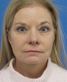 Brow Lift After Photo by Michael Epstein, MD, FACS; Northbrook, IL - Case 45602