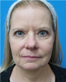 Brow Lift Before Photo by Michael Epstein, MD, FACS; Northbrook, IL - Case 45602