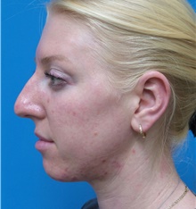 Rhinoplasty Before Photo by Michael Epstein, MD, FACS; Northbrook, IL - Case 45865