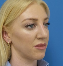 Rhinoplasty After Photo by Michael Epstein, MD, FACS; Northbrook, IL - Case 45865
