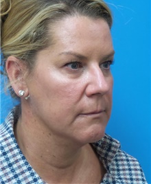 Facelift Before Photo by Michael Epstein, MD, FACS; Northbrook, IL - Case 45959