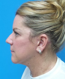 Facelift After Photo by Michael Epstein, MD, FACS; Northbrook, IL - Case 45959