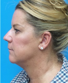 Facelift Before Photo by Michael Epstein, MD, FACS; Northbrook, IL - Case 45959