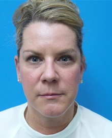Facelift After Photo by Michael Epstein, MD, FACS; Northbrook, IL - Case 45959