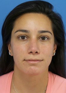 Rhinoplasty After Photo by Michael Epstein, MD, FACS; Northbrook, IL - Case 46046