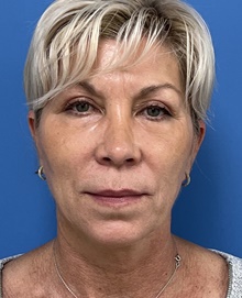 Neck Lift After Photo by Michael Epstein, MD, FACS; Northbrook, IL - Case 46370