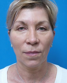 Neck Lift Before Photo by Michael Epstein, MD, FACS; Northbrook, IL - Case 46370