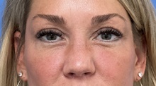 Eyelid Surgery After Photo by Michael Epstein, MD, FACS; Northbrook, IL - Case 46415