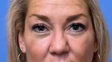 Eyelid Surgery Before Photo by Michael Epstein, MD, FACS; Northbrook, IL - Case 46415