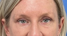 Eyelid Surgery After Photo by Michael Epstein, MD, FACS; Northbrook, IL - Case 47242