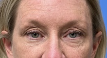 Eyelid Surgery Before Photo by Michael Epstein, MD, FACS; Northbrook, IL - Case 47242