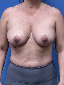 Breast Reduction After Photo by Michael Epstein, MD, FACS; Northbrook, IL - Case 47264