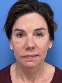 Facelift After Photo by Michael Epstein, MD, FACS; Northbrook, IL - Case 47266