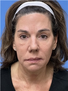 Facelift Before Photo by Michael Epstein, MD, FACS; Northbrook, IL - Case 47266