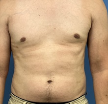 Male Breast Reduction After Photo by Michael Epstein, MD, FACS; Northbrook, IL - Case 47836