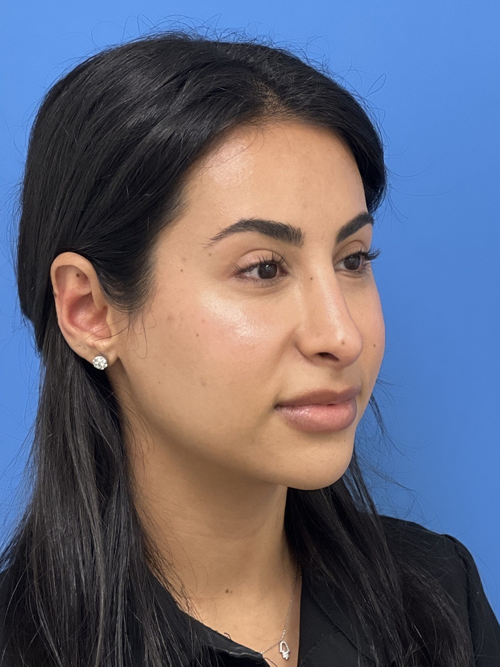 Rhinoplasty Before And After Photos By Michael Epstein, MD, FACS ...