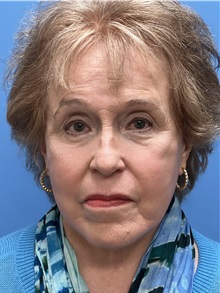 Facelift After Photo by Michael Epstein, MD, FACS; Northbrook, IL - Case 49862 Facelift After Photo by Michael Epstein, MD, FACS; Northbrook, IL - Case 49862