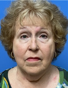 Facelift Before Photo by Michael Epstein, MD, FACS; Northbrook, IL - Case 49862 Facelift Before Photo by Michael Epstein, MD, FACS; Northbrook, IL - Case 49862