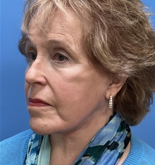 Facelift After Photo by Michael Epstein, MD, FACS; Northbrook, IL - Case 49862
