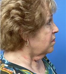 Facelift Before Photo by Michael Epstein, MD, FACS; Northbrook, IL - Case 49862