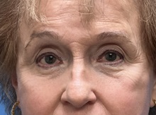 Eyelid Surgery After Photo by Michael Epstein, MD, FACS; Northbrook, IL - Case 49863 Eyelid Surgery After Photo by Michael Epstein, MD, FACS; Northbrook, IL - Case 49863