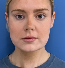 Liposuction After Photo by Michael Epstein, MD, FACS; Northbrook, IL - Case 50139