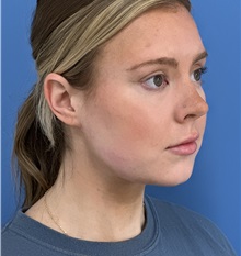 Liposuction After Photo by Michael Epstein, MD, FACS; Northbrook, IL - Case 50139