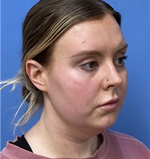 Liposuction Before Photo by Michael Epstein, MD, FACS; Northbrook, IL - Case 50139