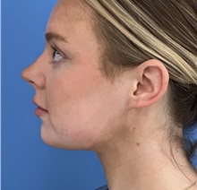 Liposuction After Photo by Michael Epstein, MD, FACS; Northbrook, IL - Case 50139